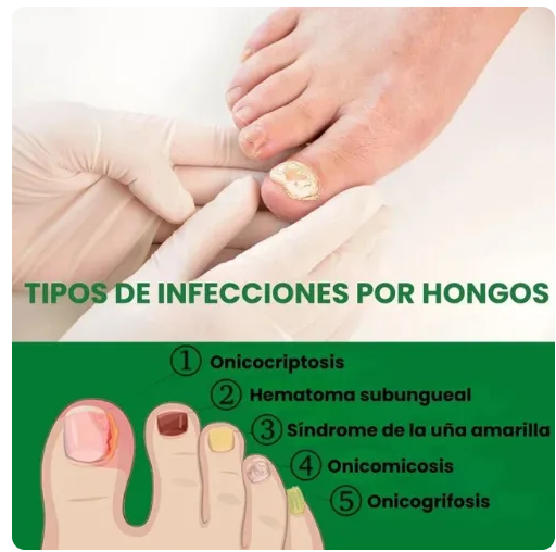 Aceite Para Hongos De Uñas - foto adicional 1